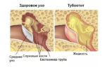 Тубоотит: как проводится лечение в домашних условиях?