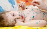 Ветрянка: симптомы и лечение в домашних условиях