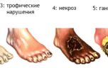 Народные средства для лечения гангрены в домашних условиях